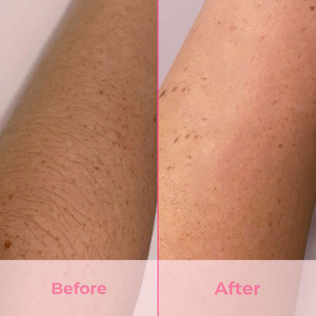 Laser Hair Removal