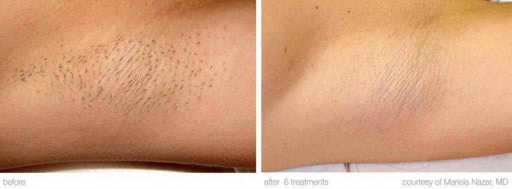 Laser Hair Removal