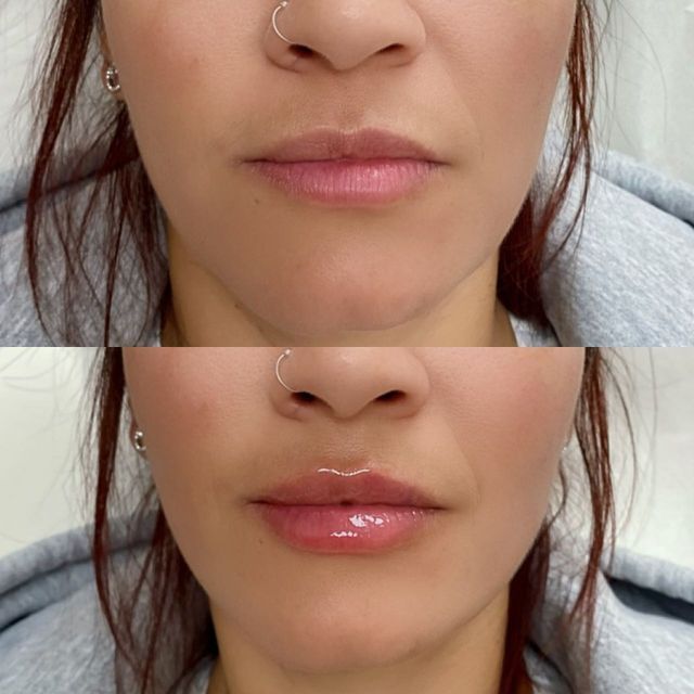 Miracle Lip Plumper